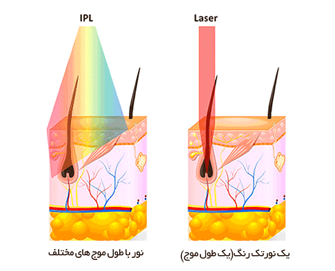 برای-حذف-موهای-زائد-ipl-بهتر-است-یا-لیزر؟ برای-حذف-موهای-زائد-ipl-بهتر-است-یا-لیزر؟